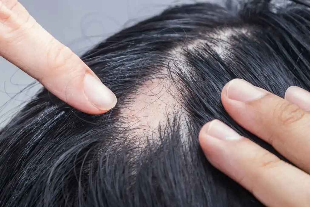 Alopecia-Treatments2-