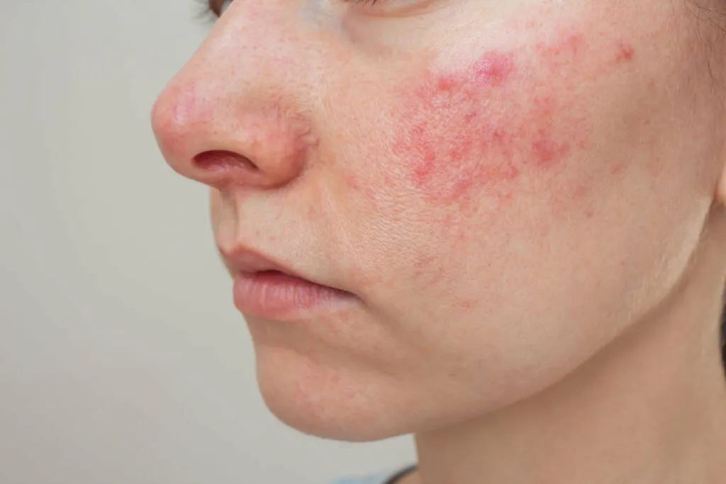 Rosacea-Treatment-unit-